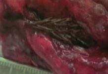 У пацієнта виявили в легкому гілочку ялини