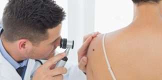 Видалення родимок і папілом: способи, відгуки, наслідки. Засіб від папілом в аптеці