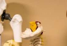 Доброякісні пухлини кісток: види, причини, симптоми, діагностика і лікування