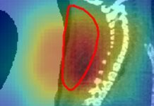 Радиоактивный Луч: Видение в Реальном Времени для Точного Бороться с Раком