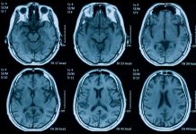 Пандемія, можливо, постаріла наш мозок ще до того, як ми заразилися covid-19