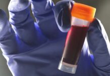 Виявляється, що одна група крові несе вищий ризик діабету 2 типу