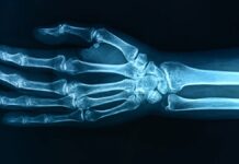 Нове дослідження пов’язує «вічні хімікати» зі зниженням щільності кісток у дітей